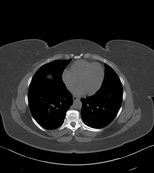 File:Calcified hepatic hydatid cyst (Radiopaedia 81127-94738 Axial non-contrast 1).jpg
