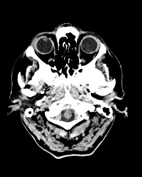File:Calcified meningioma (Radiopaedia 74361-85243 Axial non-contrast 47).jpg