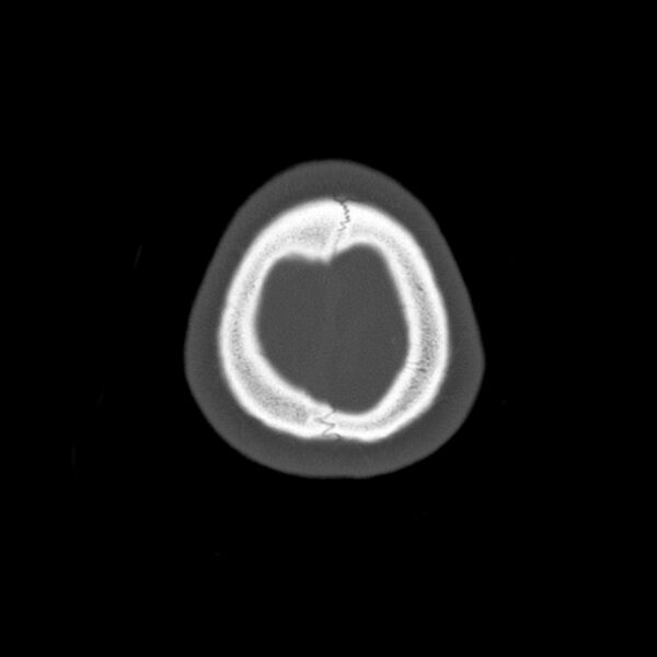 File:Calvarial osteoma (Radiopaedia 36520-38079 Axial bone window 103).jpg