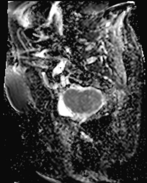 File:Cancer cervix - stage IIb (Radiopaedia 75411-86615 Sagittal ADC 15).jpg