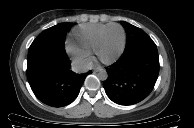 File:Cannonball metastases - uterine choriocarcinoma (Radiopaedia 70137-80173 Axial non-contrast 88).jpg