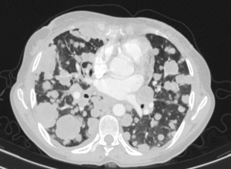 File:Cannonball metastases from breast cancer (Radiopaedia 91024-108569 Axial lung window 54).jpg