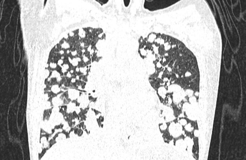 File:Cannonball metastases from breast cancer (Radiopaedia 91024-108569 Coronal lung window 64).jpg