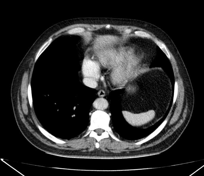 File:Carcinoid tumor with hepatic metastases (Radiopaedia 22651-22670 C 27).jpg
