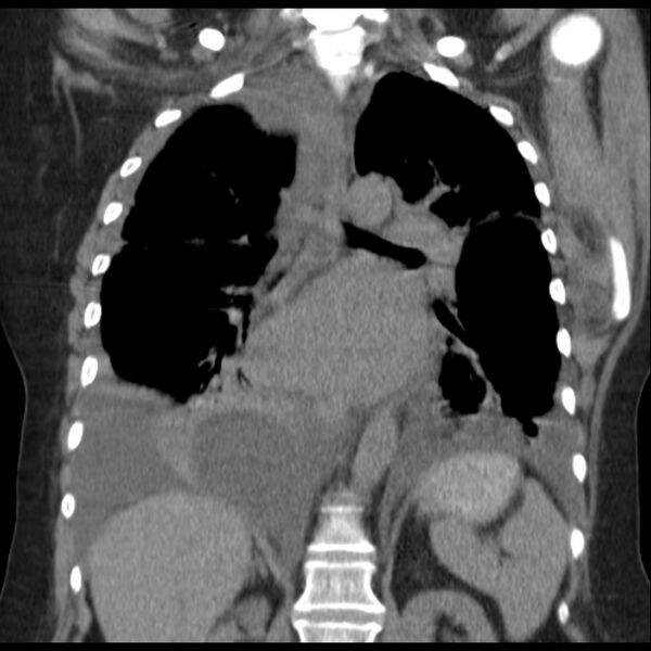 File:Cardiogenic pulmonary edema (Radiopaedia 29213-29609 Coronal non-contrast 26).jpg