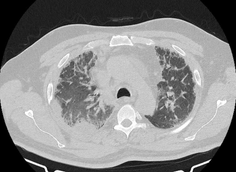 File:Cardiogenic pulmonary edema (Radiopaedia 68180-77678 Axial lung window 26).jpg