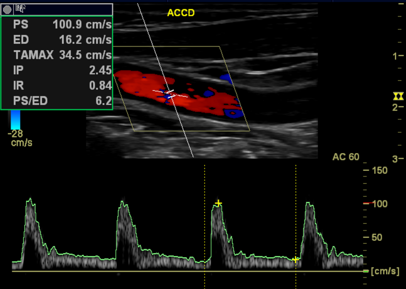 File:Carotid artery stenosis (Radiopaedia 28786-29088 C 1).png
