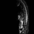 Caudal regression syndrome (Radiopaedia 61990-70072 Sagittal T2 TIRM 7).jpg