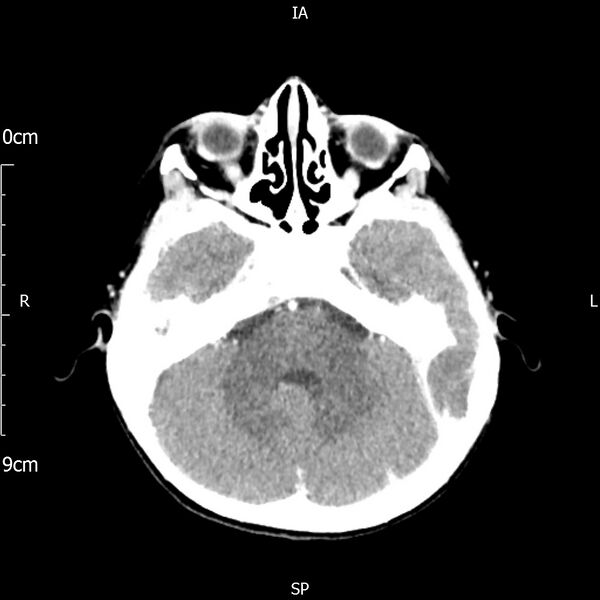 File:Cavernous sinus thrombosis (Radiopaedia 79414-92510 Axial Brain 71).jpg