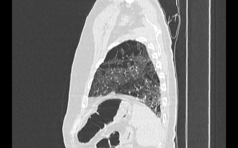 File:Cavitating bronchogenic carcinoma (Radiopaedia 44489-48162 Sagittal lung window 60).jpg