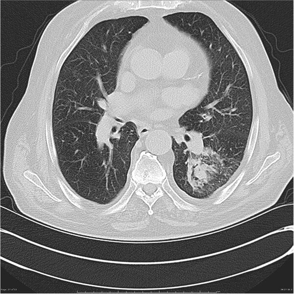 File:Cavitating left lower lobe lesion - squamous cell lung cancer (Radiopaedia 27749-28176 Axial lung window 27).jpg