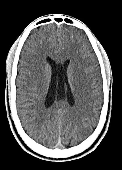 File:Cavum septum pellucidum and cavum vergae (Radiopaedia 77797-90060 Axial Brain Window 64).jpg