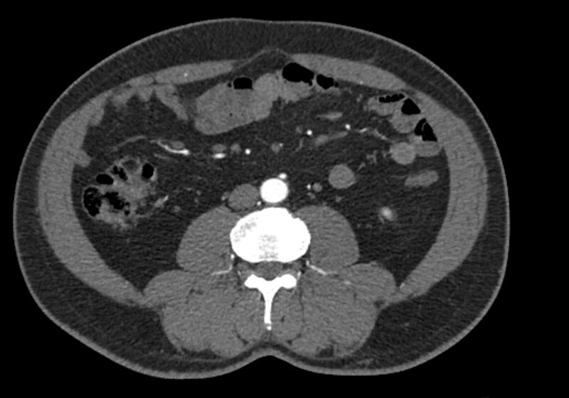 File:Celiac artery dissection (Radiopaedia 52194-58080 A 61).jpg
