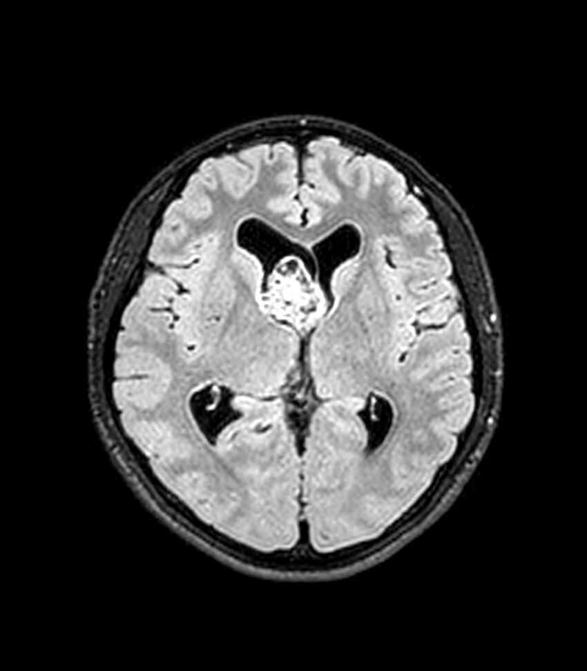 Central neurocytoma (Radiopaedia 79320-92380 Axial FLAIR 159).jpg