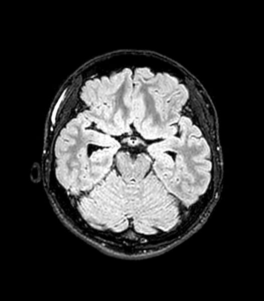 File:Central neurocytoma (Radiopaedia 79320-92380 Axial FLAIR 198).jpg
