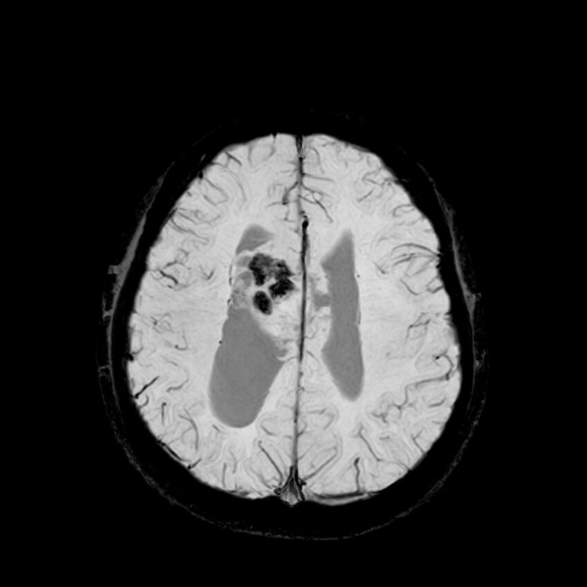 Central neurocytoma (Radiopaedia 79320-92380 Axial SWI 99).jpg