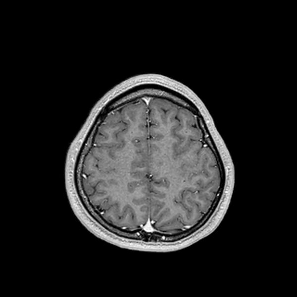 File:Central neurocytoma (Radiopaedia 79320-92380 Axial T1 C+ 190).jpg