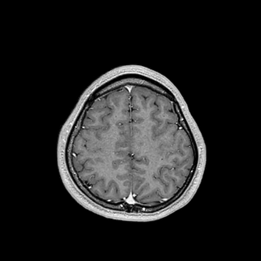 Central neurocytoma (Radiopaedia 79320-92380 Axial T1 C+ 190).jpg
