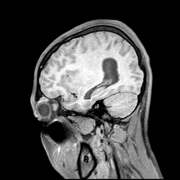 File:Central neurocytoma (Radiopaedia 79320-92380 Sagittal T1 190).jpg