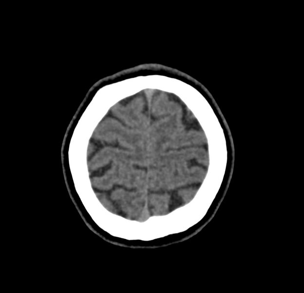File:Cerebellar agenesis (Radiopaedia 30203-30817 Axial non-contrast 45).jpg