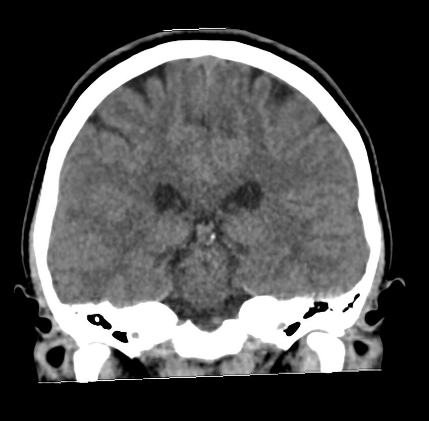 Cerebellar agenesis (Radiopaedia 30203-30817 Coronal non-contrast 24).jpg