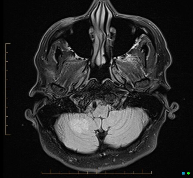 File:Cerebellar gangliocytoma (Radiopaedia 65377-74422 Axial FLAIR 5).jpg