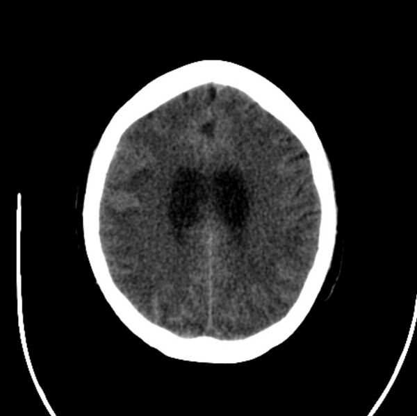 File:Cerebellar hemorrhage causing obstructive hydrocephalus (Radiopaedia 33989-35207 Axial non-contrast 36).jpg