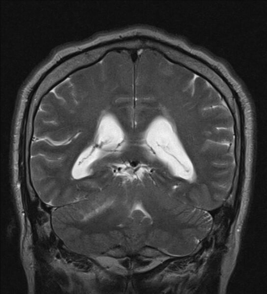 File:Cerebellopontine angle meningioma (Radiopaedia 24459-24764 Coronal T2 17).jpg