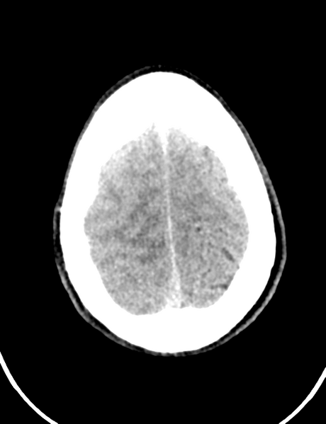 File:Cerebral abscess (Radiopaedia 60342-68008 Axial non-contrast 45).png