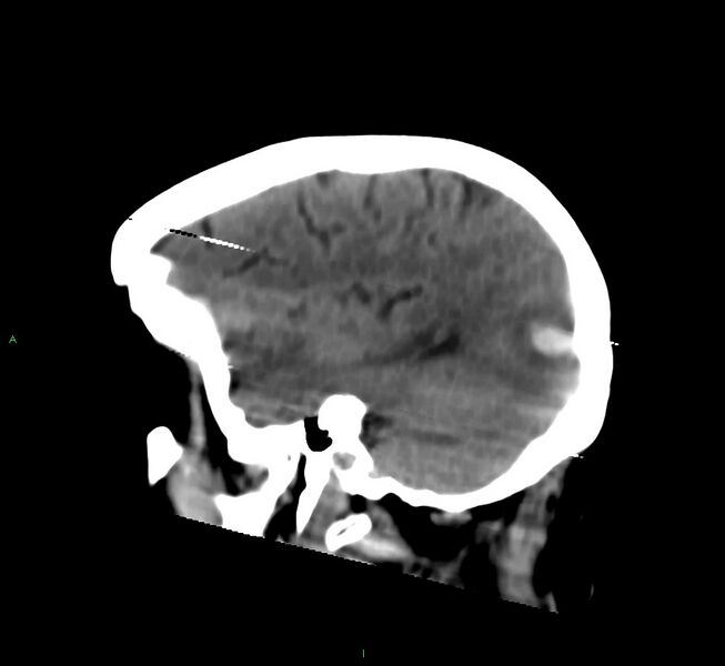 File:Cerebral amyloid angiopathy-associated lobar intracerebral hemorrhage (Radiopaedia 58377-65514 B 13).jpg