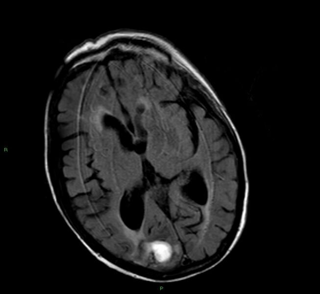 File:Cerebral amyloid angiopathy-associated lobar intracerebral hemorrhage (Radiopaedia 58377-65515 Axial FLAIR 14).jpg