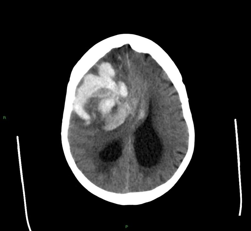 Cerebral amyloid angiopathy-associated lobar intracerebral hemorrhage (Radiopaedia 58560-65723 Axial non-contrast 18).jpg