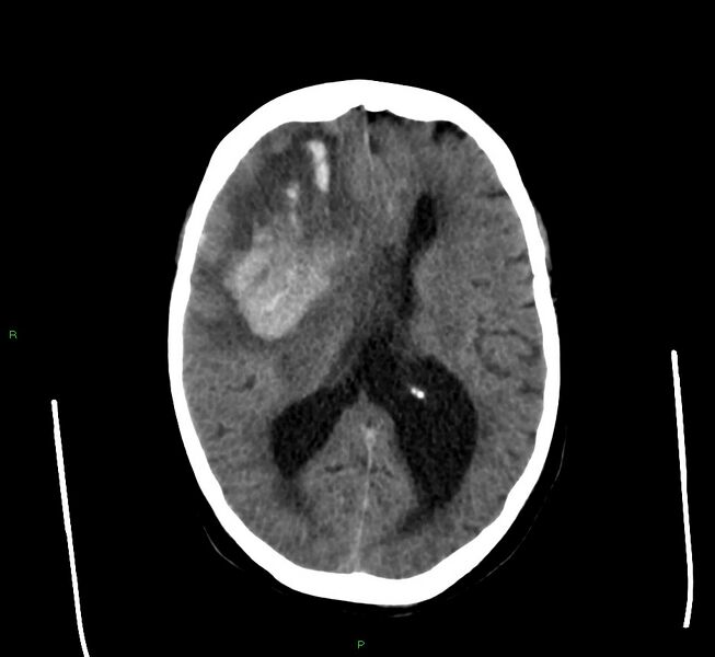 File:Cerebral amyloid angiopathy-associated lobar intracerebral hemorrhage (Radiopaedia 58560-65723 Axial non-contrast 25).jpg