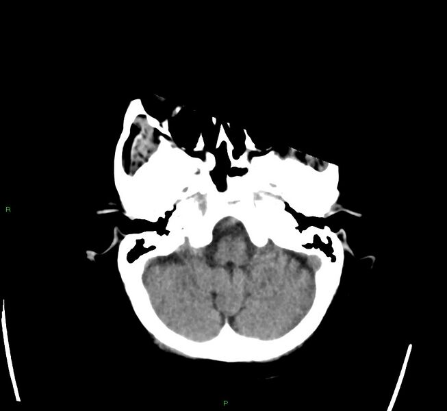 File:Cerebral amyloid angiopathy-associated lobar intracerebral hemorrhage (Radiopaedia 58563-65727 Axial non-contrast 44).jpg