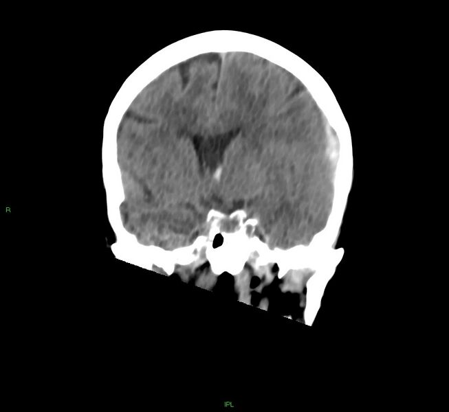 File:Cerebral amyloid angiopathy-associated lobar intracerebral hemorrhage (Radiopaedia 58754-65975 Coronal non-contrast 38).jpg