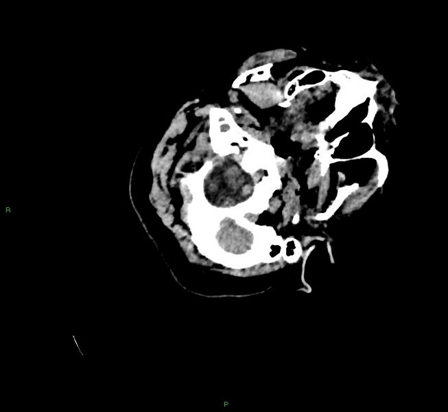 File:Cerebral amyloid angiopathy-associated lobar intracerebral hemorrhage (Radiopaedia 58757-65979 Axial non-contrast 14).jpg