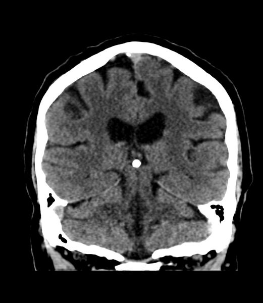 File:Cerebral dural venous sinus thrombosis (Radiopaedia 86514-102575 Coronal non-contrast 31).jpg