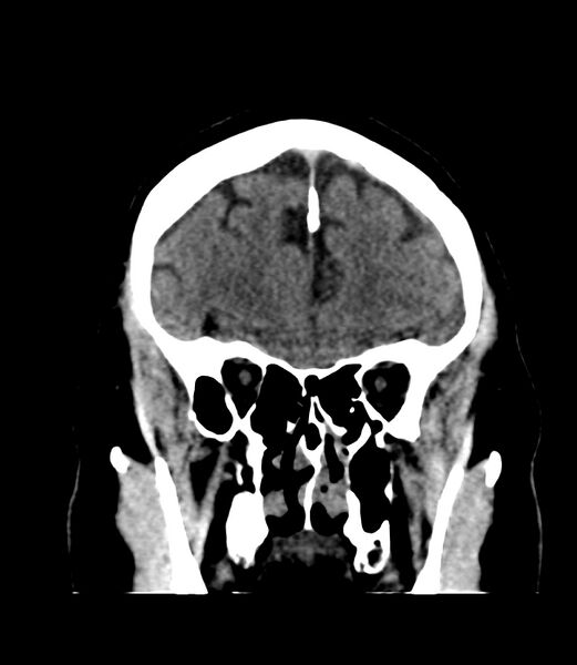 File:Cerebral dural venous sinus thrombosis (Radiopaedia 86514-102575 Coronal non-contrast 9).jpg