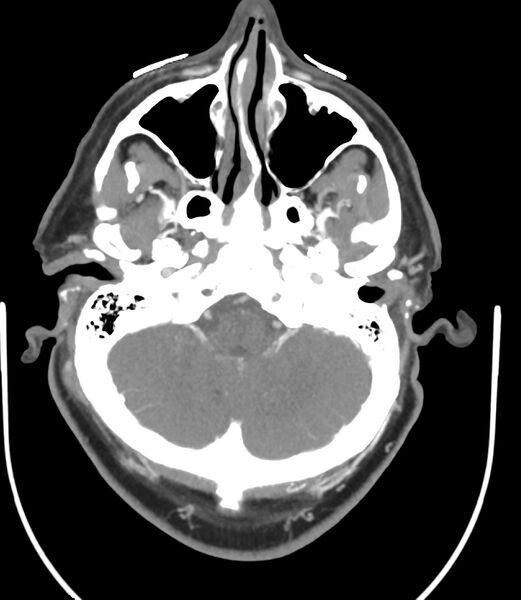 File:Cerebral dural venous sinus thrombosis (Radiopaedia 86514-102576 A 31).jpg