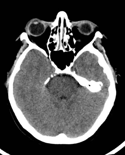File:Cerebral edema due to severe hyponatremia (Radiopaedia 89826-106938 Axial non-contrast 34).jpg