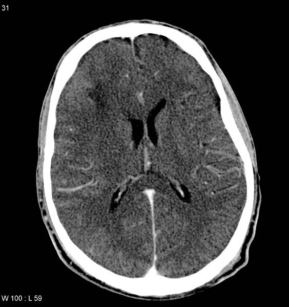 File:Cerebral metastasis - choriocarcinoma (Radiopaedia 12586).jpg