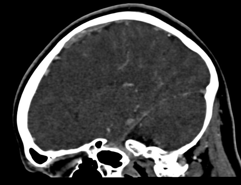 File:Cerebral venous sinus thrombosis (Radiopaedia 59224-66646 Sagittal C+ delayed 14).jpg