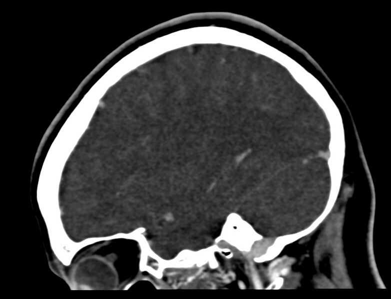 File:Cerebral venous sinus thrombosis (Radiopaedia 59224-66646 Sagittal C+ delayed 4).jpg