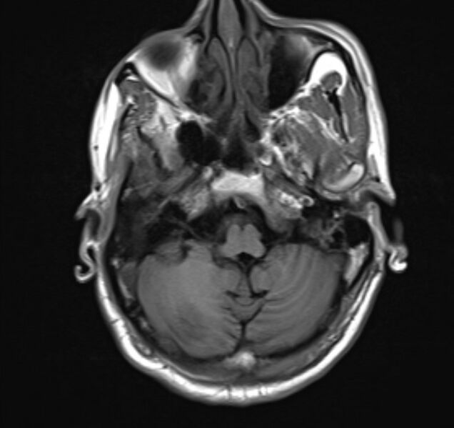 File:Cerebral venous thrombosis (Radiopaedia 71207-81504 Axial T1 6).jpg