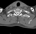 Cervical dural CSF leak on MRI and CT treated by blood patch (Radiopaedia 49748-54996 B 39).png