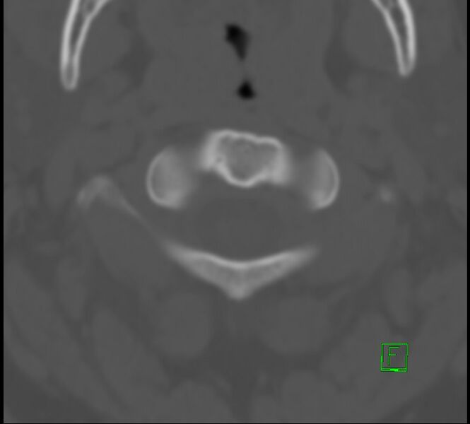 File:Cervical spine fracture - hyperflexion injury (Radiopaedia 66184-75364 Axial bone window 2).jpg