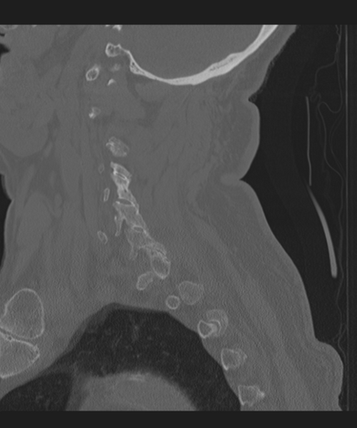 File:Cervical spine fracture in the setting of ankylosis (Radiopaedia 37038-38715 Sagittal bone window 23).png