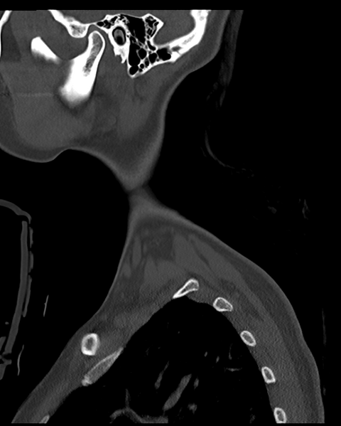 File:Cervical tuberculous spondylitis (Radiopaedia 39149-41365 Sagittal bone window 5).png