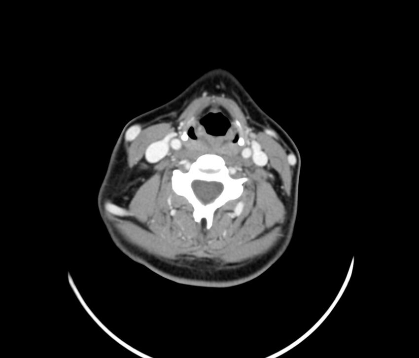 Cervical venous malformation (Radiopaedia 22653-22672 Axial C+ delayed 39).jpg