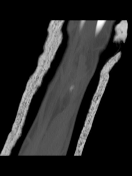 File:Chauffeur's (Hutchinson) fracture (Radiopaedia 58043-65079 Coronal bone window 14).jpg